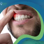علاج خراج اللثة
