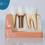 عملية زراعة الاسنان