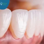 تركيب فينير للأسنان