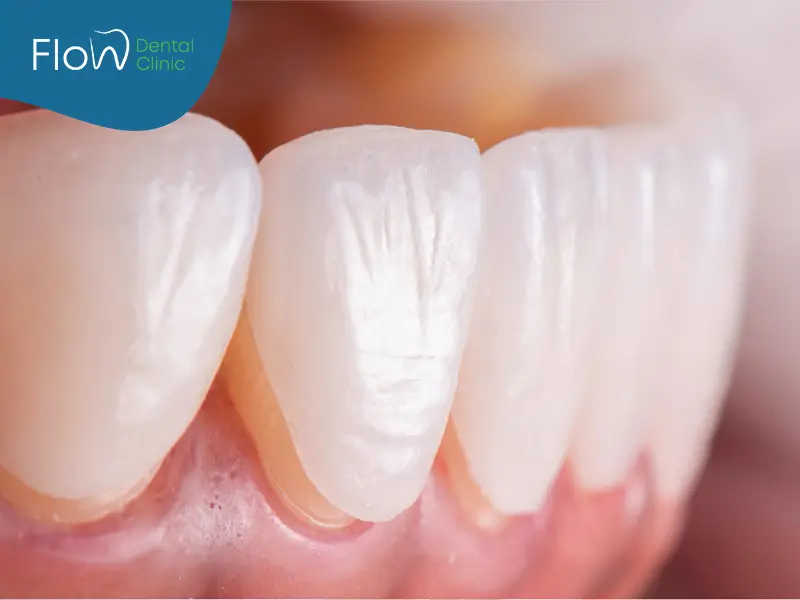 تركيب فينير للأسنان