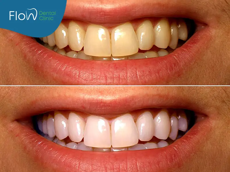 تبييض الأسنان