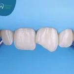 الحشوات التجميلية لسد الفراغات