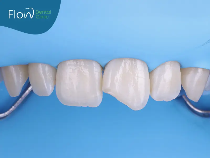 الحشوات التجميلية لسد الفراغات