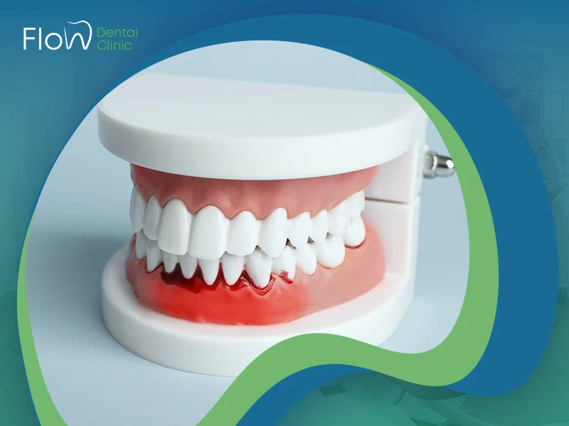 تعرف إلى أعراض التهابات اللثة وعلاجها