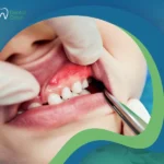 علاج التهاب اللثة للأطفال