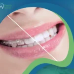 تقويم الأسنان قبل وبعد | رحلة نحو ابتسامة مثالية
