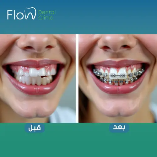 تقويم الاسنان قبل وبعد