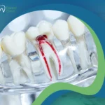 علاج الجذور للأسنان