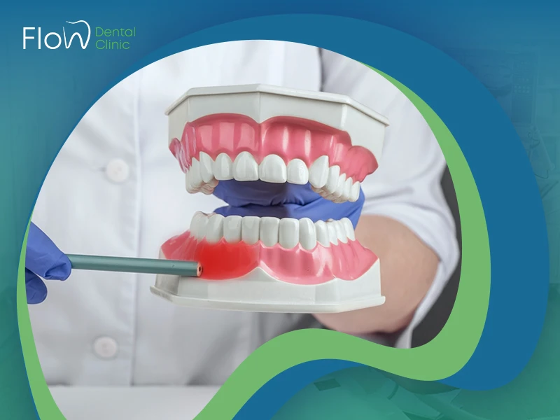 علاج جيوب اللثة