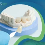 تركيب فينير للأسنان