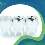 تعرف إلى أنواع الحشوات التجميلية للأسنان