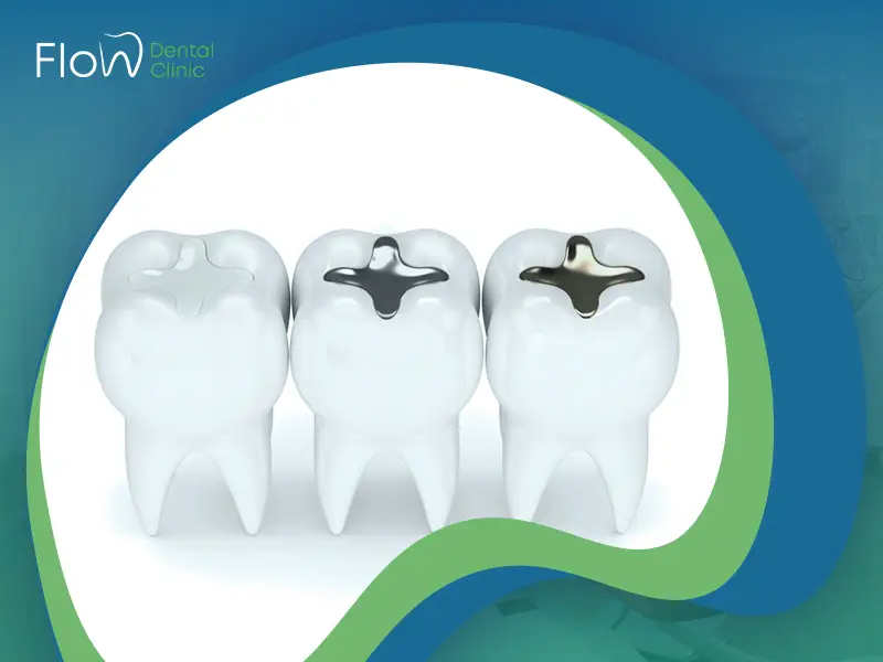أنواع الحشوات التجميلية للأسنان