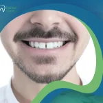 أفضل وسائل علاج فراغات الأسنان