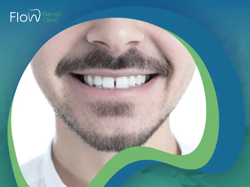 علاج فراغات الأسنان