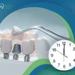 مدة زراعة الأسنان بعد الخلع| التوقيت المناسب