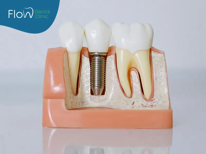 عملية زراعة الاسنان