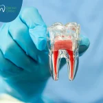 علاج الجذور للأسنان