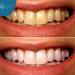 تبييض الأسنان| الوسيلة المثالية للحصول على ابتسامة جذابة