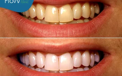 تبييض الأسنان| الوسيلة المثالية للحصول على ابتسامة جذابة