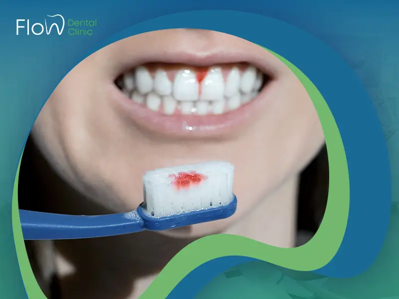 أسباب التهاب اللثة