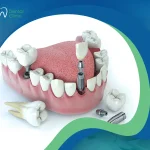 أفضل أنواع زراعة الأسنان