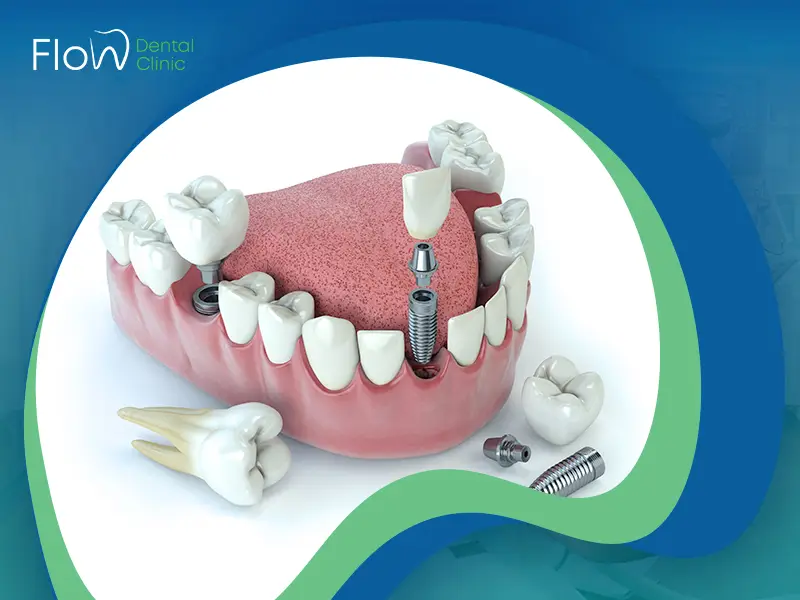 أنواع زراعة الأسنان