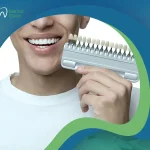 كيف ستكون تجربتي مع الفينير؟