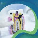تسوس جذور الأسنان: خطر يهدد أسنانك