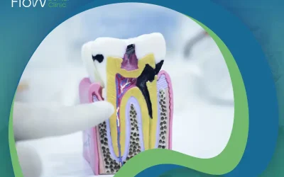 تسوس جذور الأسنان: خطر يهدد أسنانك