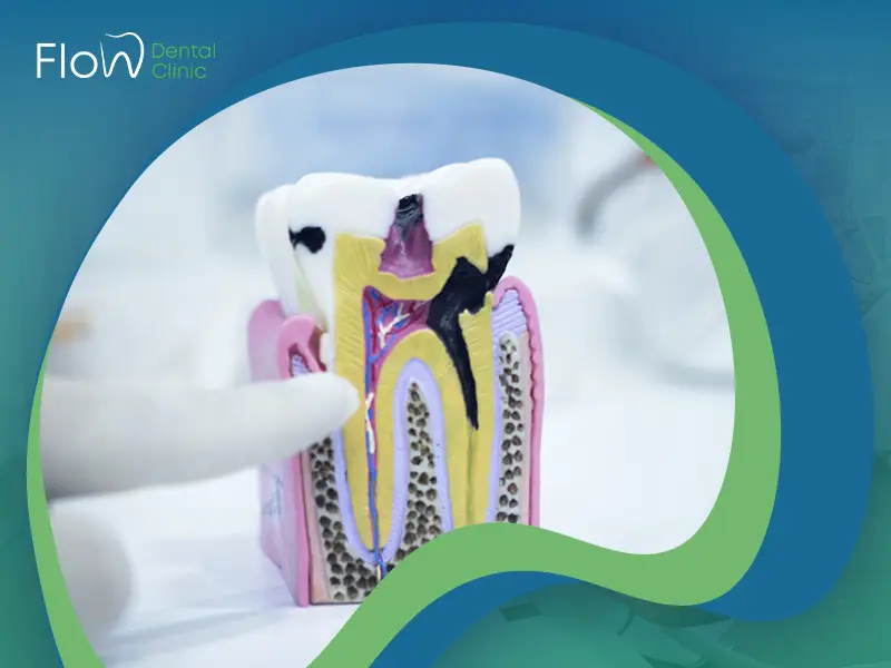 تسوس جذور الأسنان