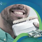 هل سعر فينير الأسنان في متناول الجميع؟