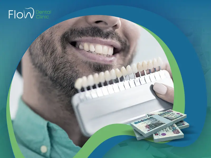 سعر فينير الأسنان