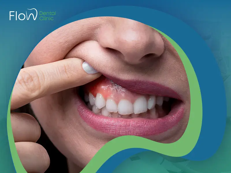 شكل خراج اللثة