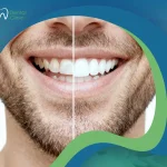 نتائج فينير الأسنان قبل وبعد | حل يمنحك ابتسامة أكثر إشراقًا