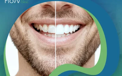 نتائج فينير الأسنان قبل وبعد | حل يمنحك ابتسامة أكثر إشراقًا