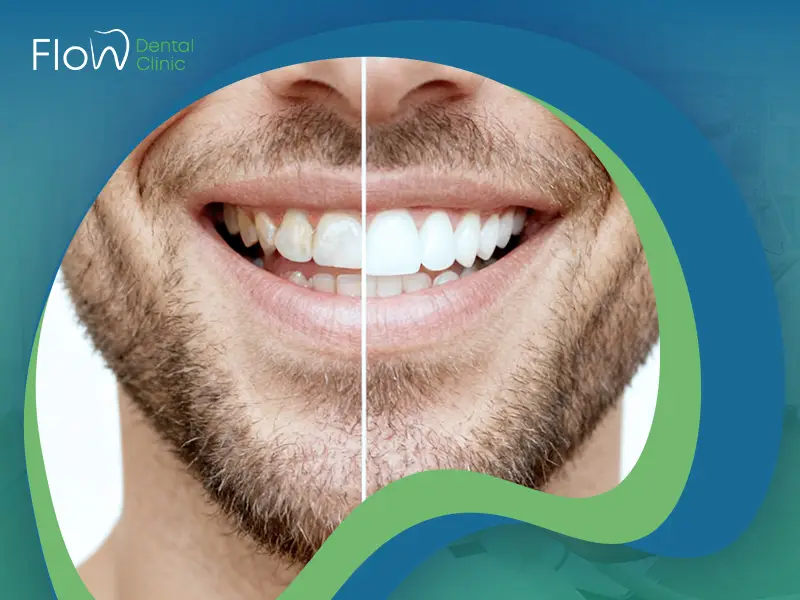 فينير الأسنان قبل وبعد