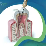 كل ما يهمك معرفته عن حشو العصب