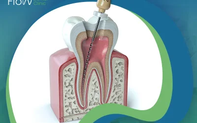 كل ما يهمك معرفته عن حشو العصب