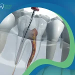 كيف يتحدد سعر حشو العصب في مصر؟