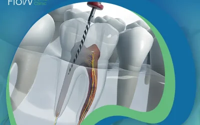 كيف يتحدد سعر حشو العصب في مصر؟