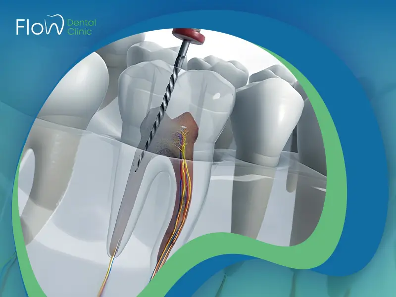 سعر حشو العصب في مصر