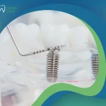 ما بدائل زراعة الأسنان؟ إليكم أفضلها