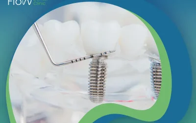 ما بدائل زراعة الأسنان؟ إليكم أفضلها