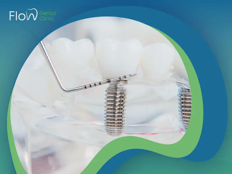 بدائل زراعة الأسنان