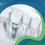 إيجابيات وسلبيات زراعة الأسنان الفورية