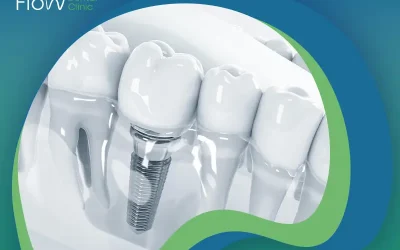 إيجابيات وسلبيات زراعة الأسنان الفورية