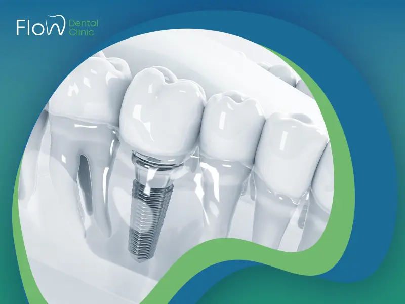 زراعة الأسنان الفورية