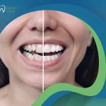 دليلك الكامل حول نتائج زراعة الاسنان قبل وبعد لضمان ابتسامة طبيعية