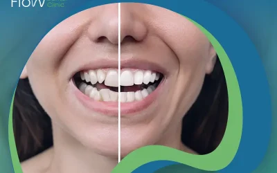 دليلك الكامل حول نتائج زراعة الاسنان قبل وبعد لضمان ابتسامة طبيعية