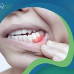 دليلك الشامل حول أساليب علاج نزيف اللثة